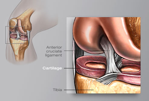 knee replacment